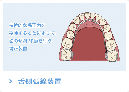 舌側弧線装置 持続的な矯正力を 発揮することによって、歯の傾斜 移動を行う 矯正装置